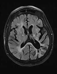 White matter disease